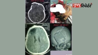 Girl's two-month intensive treatment: Cranioplasty surgery reattachs fractured skull bone to brain